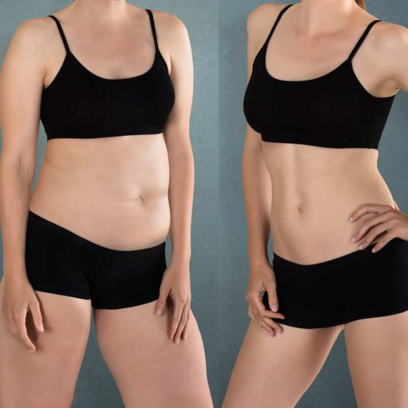 Does Fat Freezing at Home Work? DIY Devices vs Professional Cryolipolysis 2 before and after Cryolipolysis Lancashire